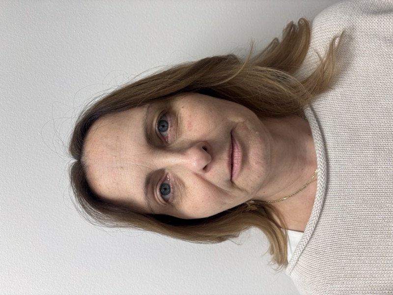 Dermal Fillers Before & After Image