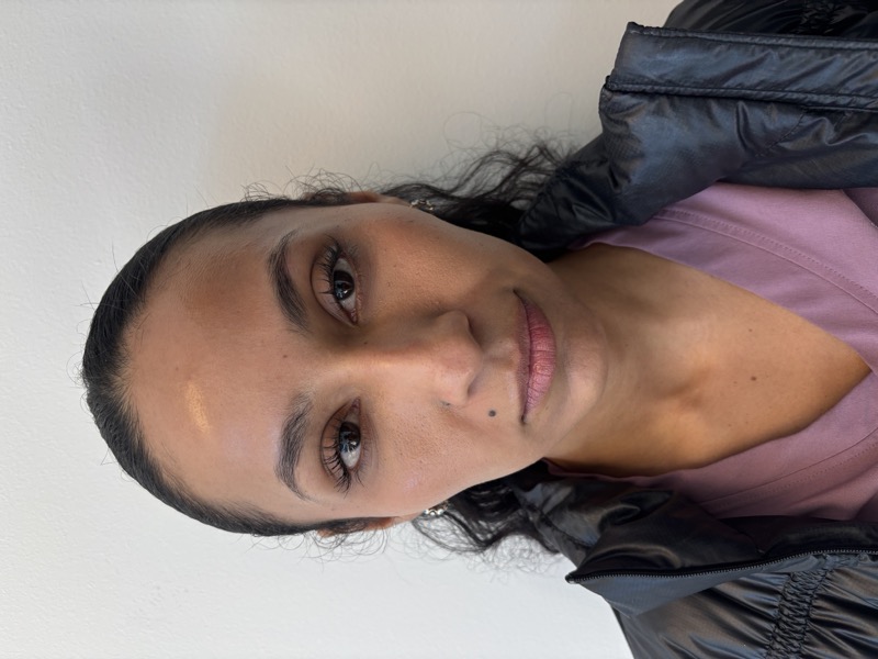 Dermal Fillers Before & After Image