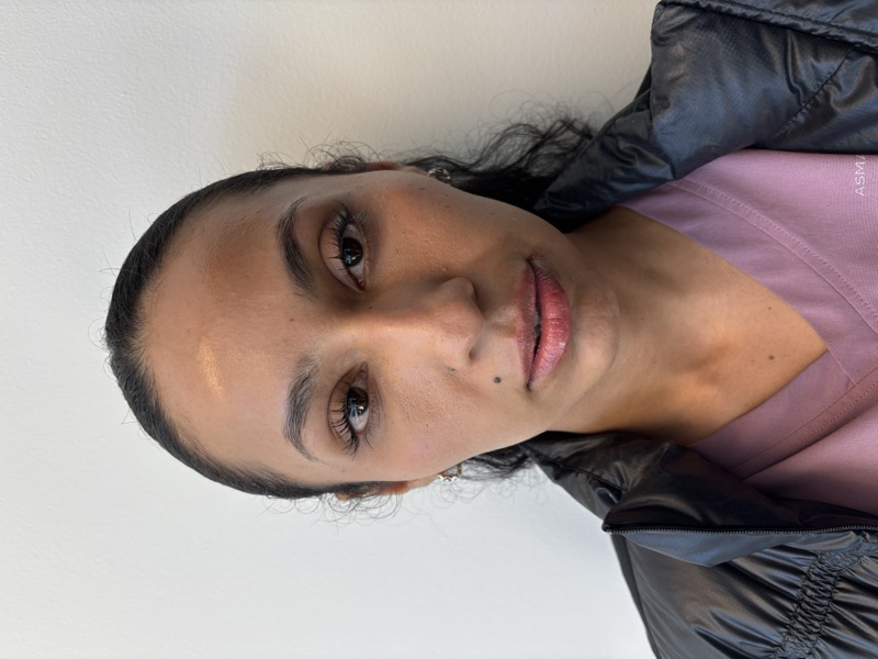 Dermal Fillers Before & After Image