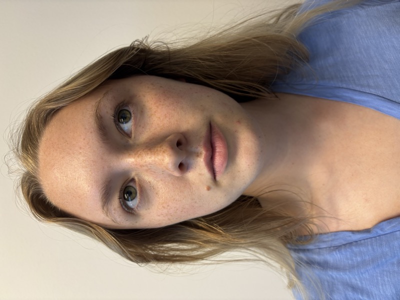 Dermal Fillers Before & After Image