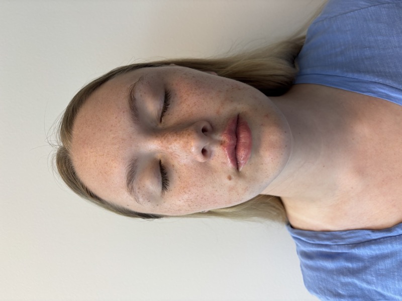 Dermal Fillers Before & After Image