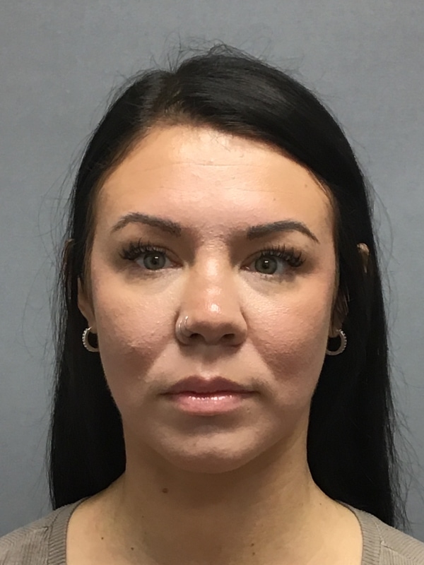 Dermal Fillers Before & After Image