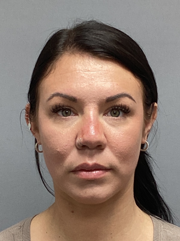 Dermal Fillers Before & After Image