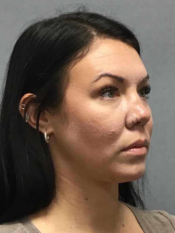 Dermal Fillers Before & After Image