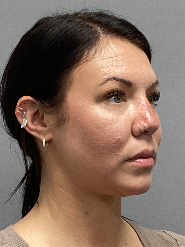 Dermal Fillers Before & After Image