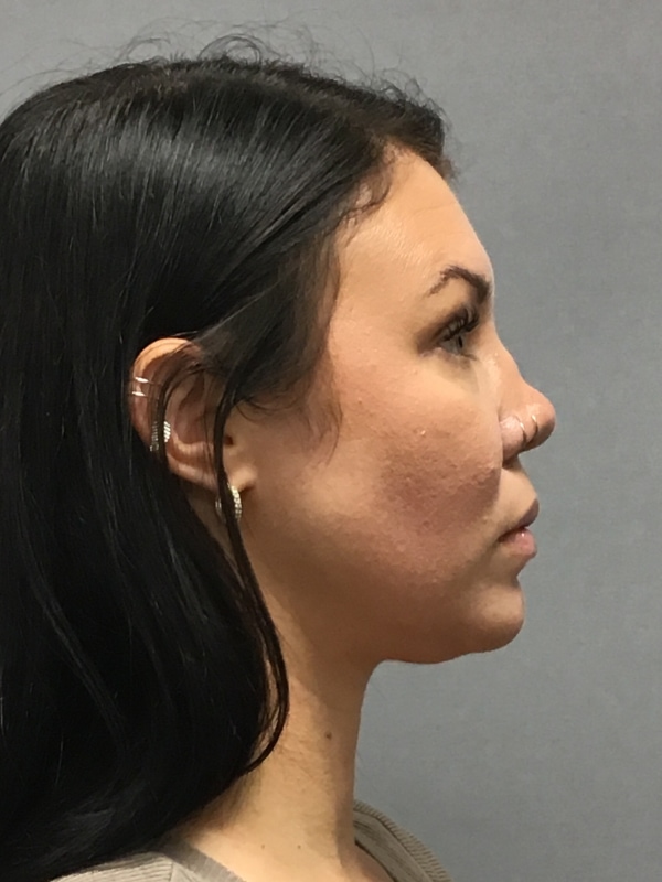 Dermal Fillers Before & After Image
