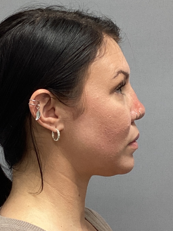 Dermal Fillers Before & After Image