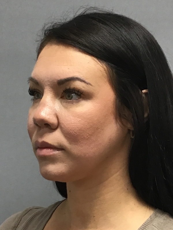 Dermal Fillers Before & After Image