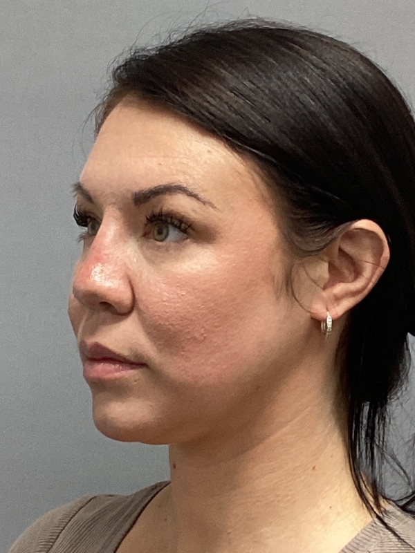 Dermal Fillers Before & After Image
