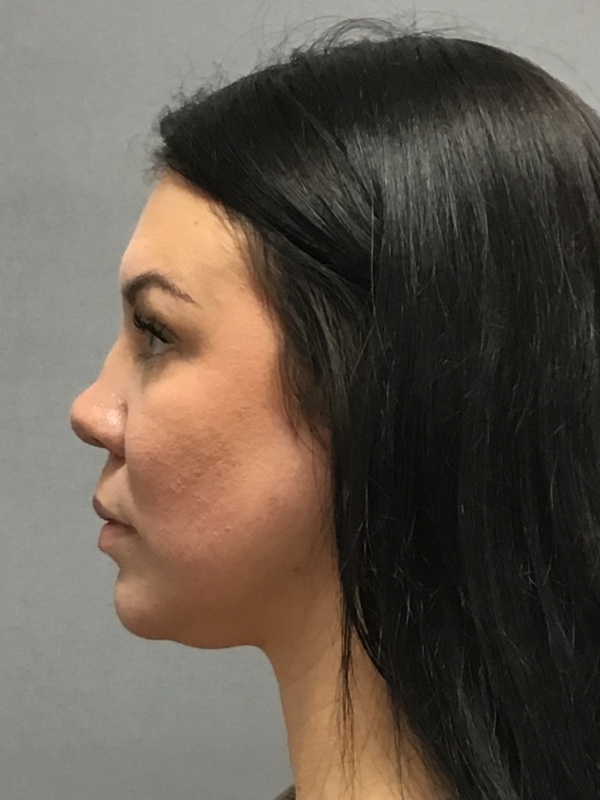 Dermal Fillers Before & After Image
