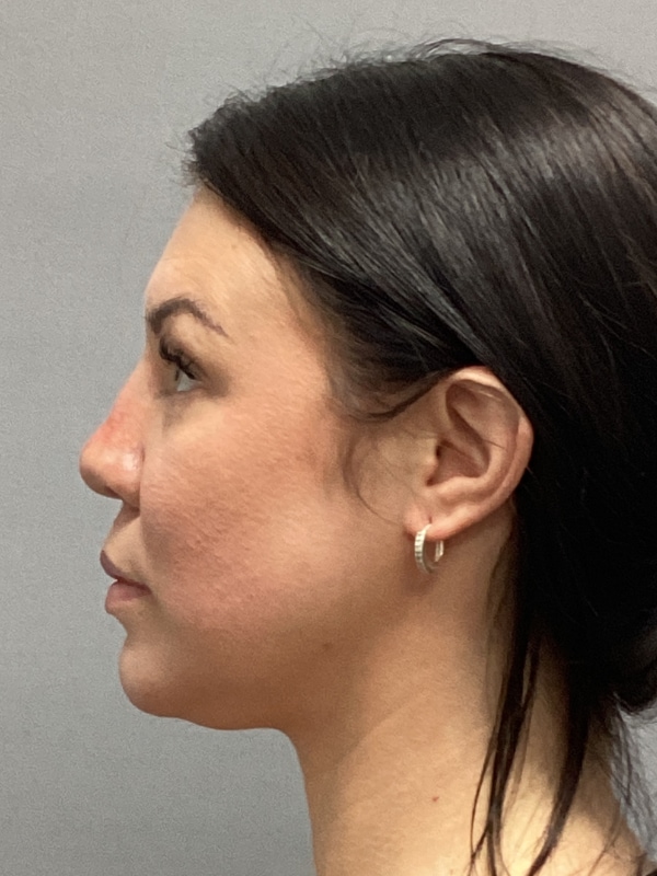 Dermal Fillers Before & After Image