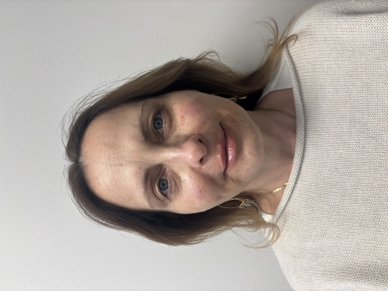 Facial Balancing Before & After Image