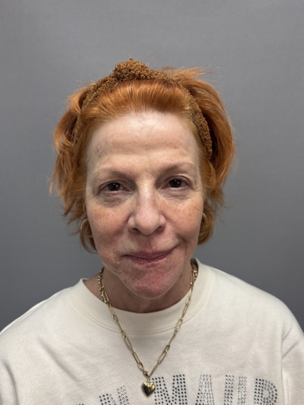 Facial Balancing Before & After Image