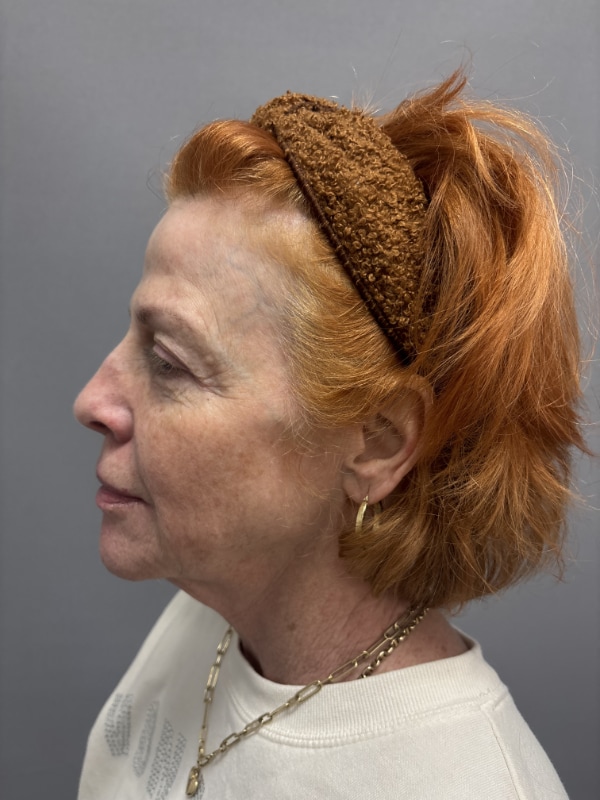 Facial Balancing Before & After Image