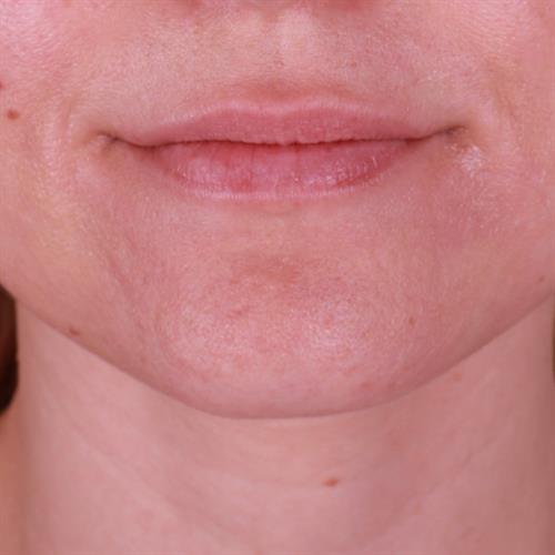 Juvederm Before & After Image