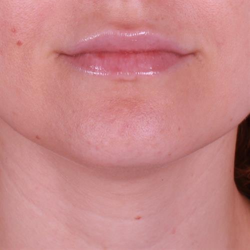 Juvederm Before & After Image