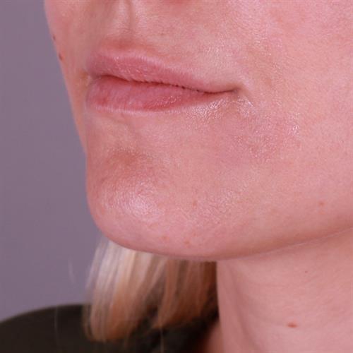 Juvederm Before & After Image