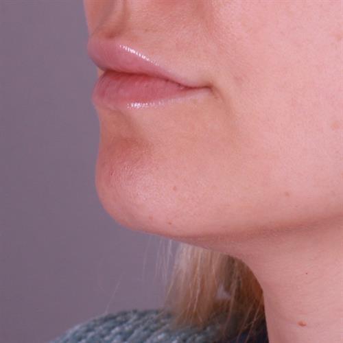 Juvederm Before & After Image