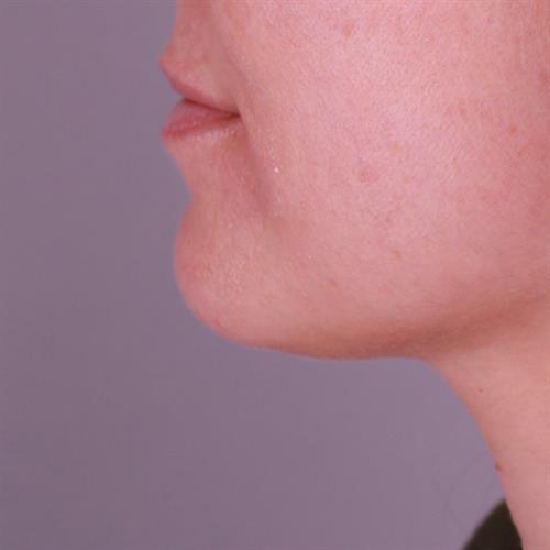 Juvederm Before & After Image