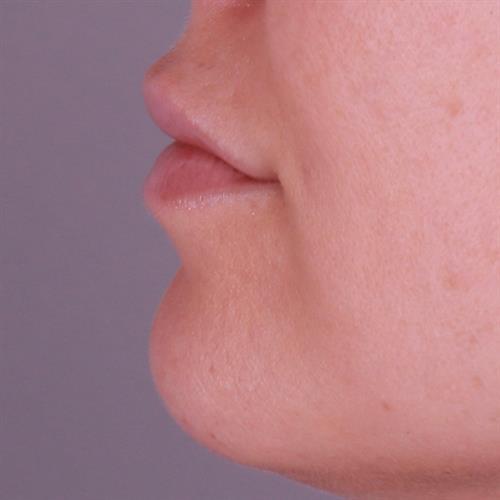 Juvederm Before & After Image