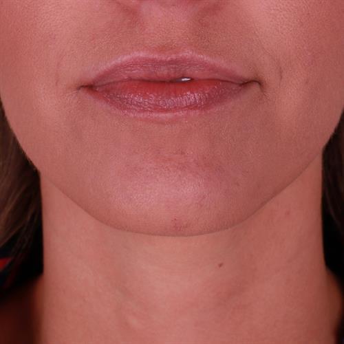 Juvederm Before & After Image