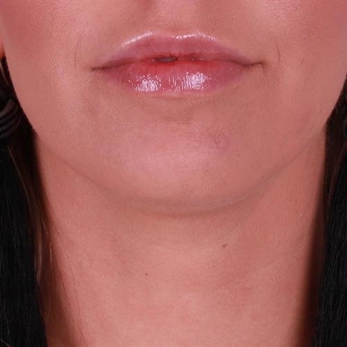 Juvederm Before & After Image