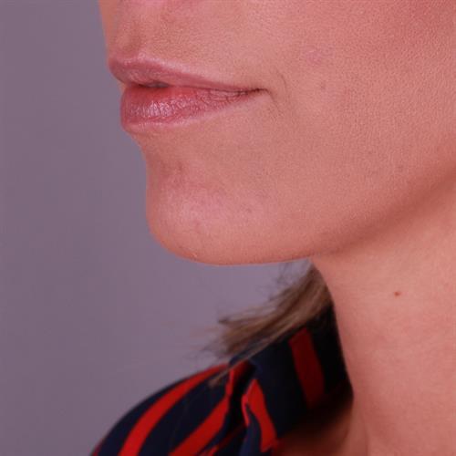 Juvederm Before & After Image