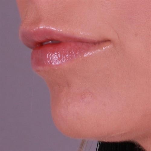 Juvederm Before & After Image