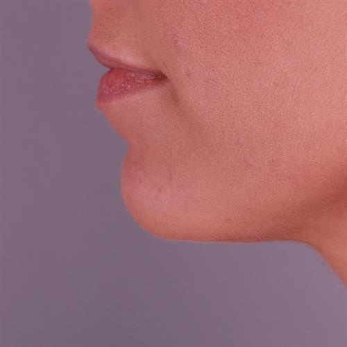 Juvederm Before & After Image