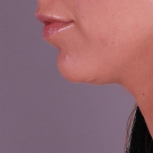 Juvederm Before & After Image