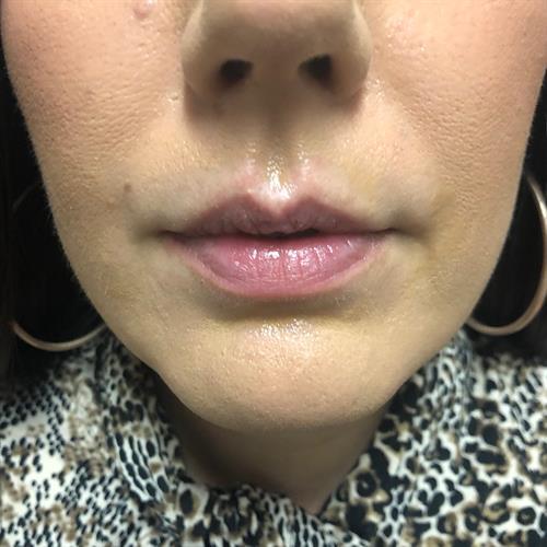 Juvederm Before & After Image