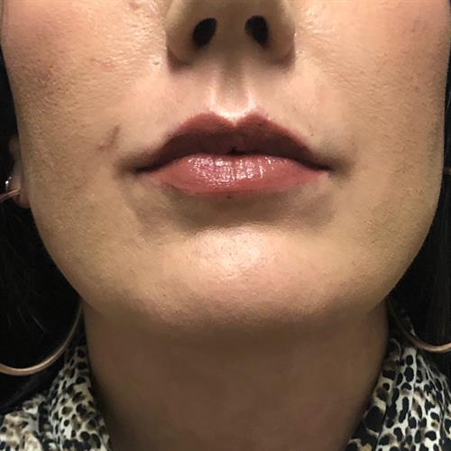 Juvederm Before & After Image