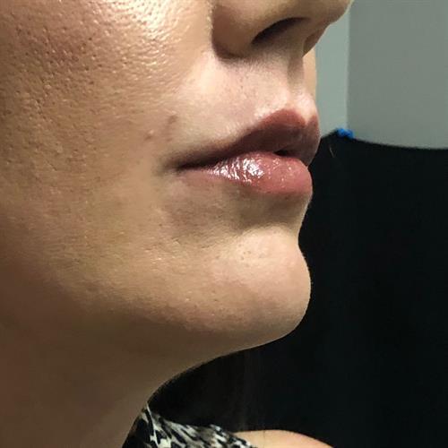 Juvederm Before & After Image