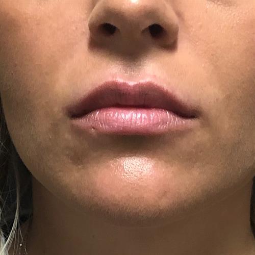 Juvederm Before & After Image