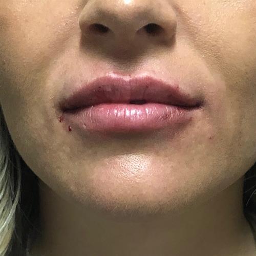 Juvederm Before & After Image