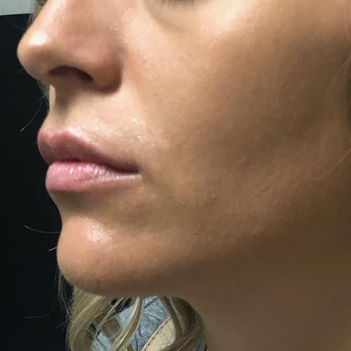 Juvederm Before & After Image