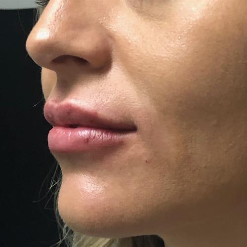 Juvederm Before & After Image