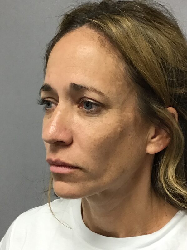 Sculptra Before & After Image
