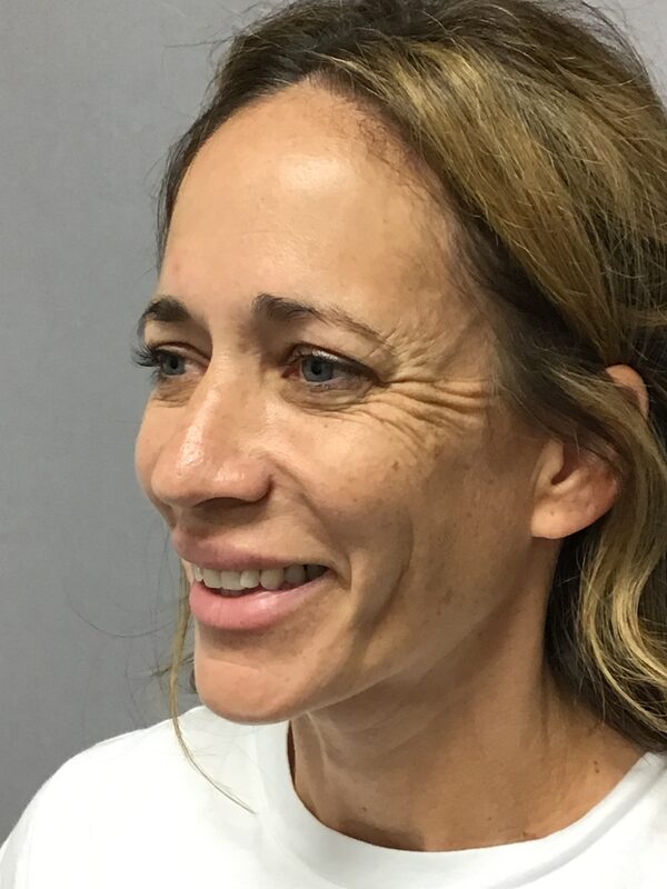 Sculptra Before & After Image