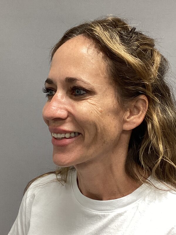 Sculptra Before & After Image