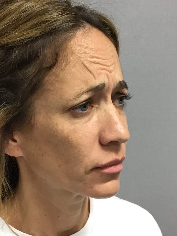 Sculptra Before & After Image