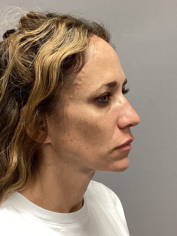 Sculptra Before & After Image
