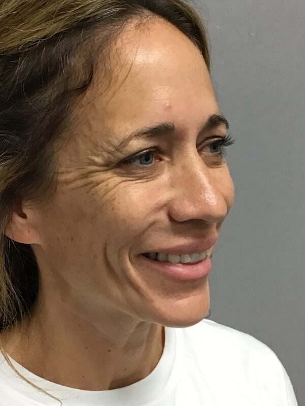 Sculptra Before & After Image