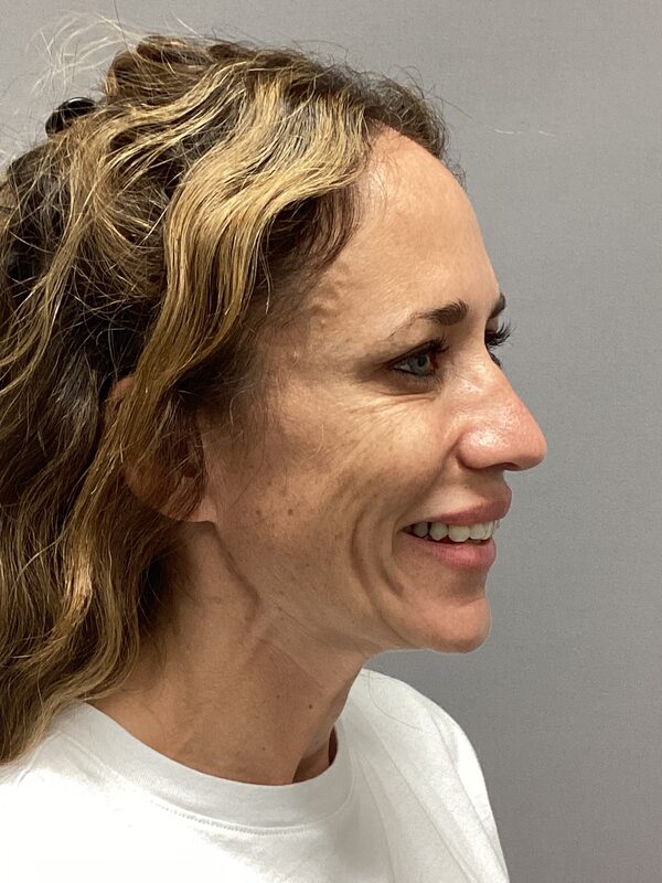 Sculptra Before & After Image